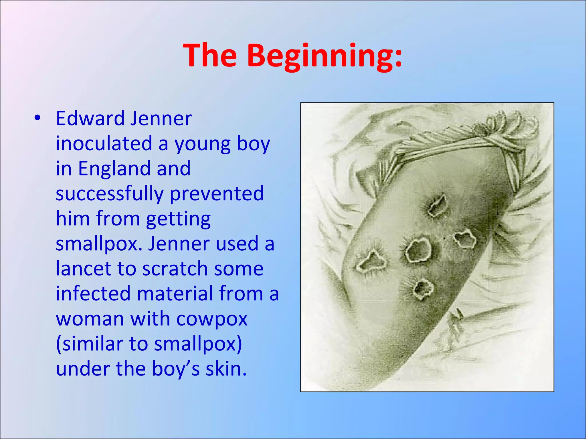 The Beginning: Edward Jenner inoculated a young boy in England and successfully prevented him from getting smallpox. Jenner used a lancet to scratch some infected material from a woman with cowpox (similar to smallpox) under the boy’s skin . 