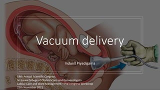 Vacuum delivery
Indunil Piyadigama
54th Annual Scientific Congress
Sri Lanka College of Obstetricians and Gynaecologists
Labour Care and Ward Management – Pre-congress Workshop
25th November 2021
 