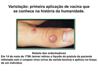 Variolação: primeira aplicação de vacina que
se conhece na história da humanidade.
Nódulo dos ordenhadores
Em 14 de maio de 1796 Jenner retirou o líquido da pústula da paciente
infectada com o cowpox vírus (vírus da varíola bovina) e aplicou no braço
de um indivíduo.
 