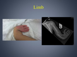 Limb 
 