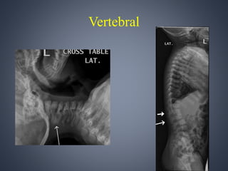 Vertebral 
 