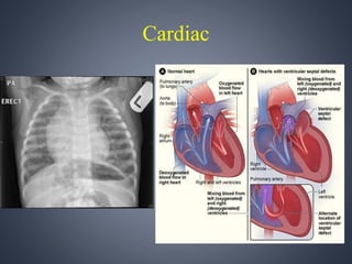 Cardiac 
 