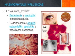 HAEMOPHYLUS INFLUENZAE
• En los niños, produce:
• Bacteriemia y meningitis
bacteriana aguda.
• Ocasionalmente celulitis,
osteomielitis, epiglotitis e
infecciones asociadas.
 