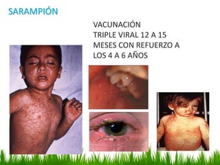SARAMPIÓN
VACUNACIÓN
TRIPLE VIRAL 12 A 15
MESES CON REFUERZO A
LOS 4 A 6 AÑOS
 