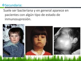 ❖Secundaria:
Suele ser bacteriana y en general aparece en
pacientes con algún tipo de estado de
inmunosupresión.
 