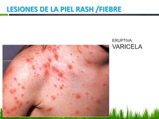 LESIONES DE LA PIEL RASH /FIEBRE
ERUPTIVA:
VARICELA
 