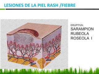 LESIONES DE LA PIEL RASH /FIEBRE
ERUPTIVA:
SARAMPION
RUBEOLA
ROSEOLA I
 
