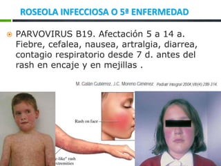 ROSEOLA INFECCIOSA O 5ª ENFERMEDAD
 PARVOVIRUS B19. Afectación 5 a 14 a.
Fiebre, cefalea, nausea, artralgia, diarrea,
contagio respiratorio desde 7 d. antes del
rash en encaje y en mejillas .
 