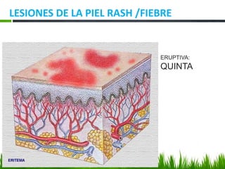 LESIONES DE LA PIEL RASH /FIEBRE
ERUPTIVA:
QUINTA
 