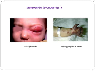 Haemophylusinfluenzaetipo BCelulitis periorbitalSepsis y gangrena en la mano