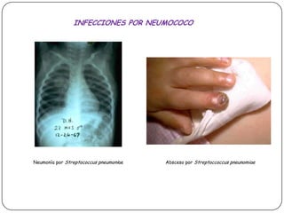 INFECCIONES POR NEUMOCOCONeumonía por StreptococcuspneumoniaeAbsceso por Streptoccoccuspneunomiae