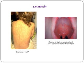 SARAMPIÓNManchas de Koplik en la mucosa bucal, como signo característico del sarampiónExantema  o “rash”