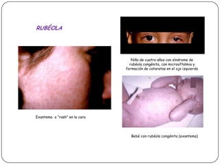 RUBÉOLANiño de cuatro años con síndrome de rubéola congénita, con microoftalmia y formación de cataratas en el ojo izquierdoExantema  o “rash” en la caraBebé con rubéola congénita (exantema)