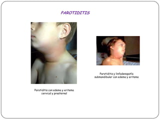PAROTIDITISParotiditis y linfadenopatíasubmandibular con edema y eritemaParotiditis con edema y eritema cervical y presternal