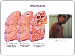 TUBERCULOSISNiño con tuberculosisInfección tuberculosa inicial en el lóbulo superior derechoPlaca inicial activa progresa hacia una cavitaciónNumerosas cavidades tuberculosas y erosión bronquial