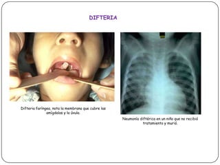 DIFTERIADifteria faríngea, nota la membrana que cubre las amígdalas y la úvula.Neumonía diftérica en un niño que no recibió tratamiento y murió.