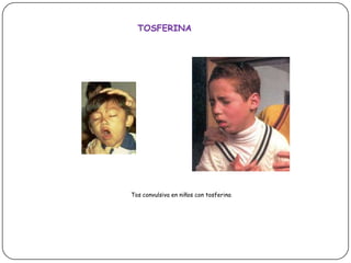 TOSFERINATos convulsiva en niños con tosferina