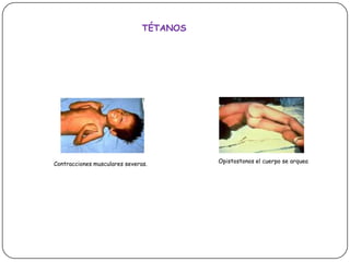 TÉTANOSOpistostonos el cuerpo se arquea Contracciones musculares severas.