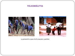 POLIOMIELITISLa poliomielitis causa atrofia muscular y parálisis