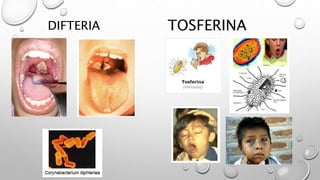 DIFTERIA TOSFERINA
 