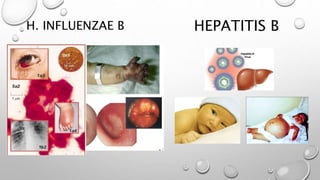 H. INFLUENZAE B HEPATITIS B
 