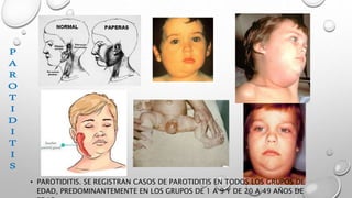 • PAROTIDITIS. SE REGISTRAN CASOS DE PAROTIDITIS EN TODOS LOS GRUPOS DE
EDAD, PREDOMINANTEMENTE EN LOS GRUPOS DE 1 A 9 Y DE 20 A 49 AÑOS DE
 