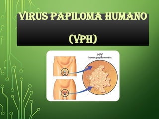 VIRUS PAPILOMA HUMANO
(VPH)
 