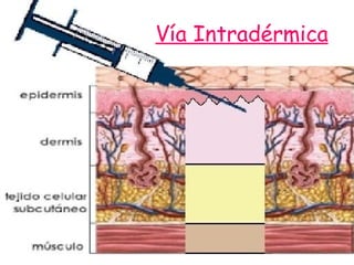 Vía Intradérmica 