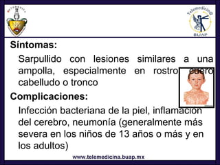 Síntomas:
  Sarpullido con lesiones similares a una
  ampolla, especialmente en rostro, cuero
  cabelludo o tronco
Complicaciones:
  Infección bacteriana de la piel, inflamación
  del cerebro, neumonía (generalmente más
  severa en los niños de 13 años o más y en
  los adultos)
 