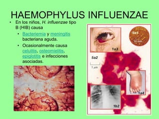 HAEMOPHYLUS INFLUENZAE
•   En los niños, H. influenzae tipo
    B (HIB) causa
     • Bacteriemia y meningitis
       bacteriana aguda.
     • Ocasionalmente causa
       celulitis, osteomielitis,
       epiglotitis e infecciones
       asociadas.
 