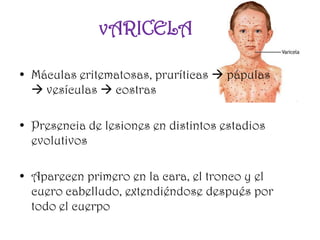 vARICELA

• Máculas eritematosas, pruríticas  pápulas
   vesículas  costras

• Presencia de lesiones en distintos estadios
  evolutivos

• Aparecen primero en la cara, el tronco y el
  cuero cabelludo, extendiéndose después por
  todo el cuerpo
 