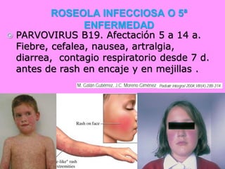 ROSEOLA INFECCIOSA O 5ª
                ENFERMEDAD
   PARVOVIRUS B19. Afectación 5 a 14 a.
    Fiebre, cefalea, nausea, artralgia,
    diarrea, contagio respiratorio desde 7 d.
    antes de rash en encaje y en mejillas .
 