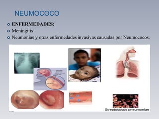 NEUMOCOCO
 ENFERMEDADES:
 Meningitis
 Neumonías y otras enfermedades invasivas causadas por Neumococos.
 