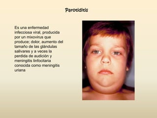 Parotiditis

Es una enfermedad
infecciosa viral, producida
por un mixovirus que
produce; dolor, aumento del
tamaño de las glándulas
salivares y a veces la
perdida de audición y
meningitis linfocitaria
conocida como meningitis
uriana

 