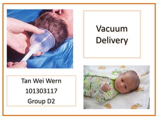 Vacuum
Delivery
Tan Wei Wern
101303117
Group D2
 