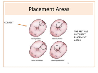 Placement Areas
CORRECT
THE REST ARE
INCORRECT
PLACEMENT
AREAS
 