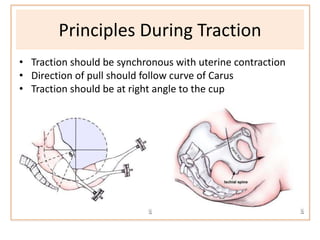 • Traction should be synchronous with uterine contraction
• Direction of pull should follow curve of Carus
• Traction should be at right angle to the cup
Principles During Traction
 