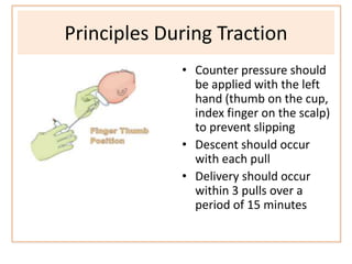 Principles During Traction
• Counter pressure should
be applied with the left
hand (thumb on the cup,
index finger on the scalp)
to prevent slipping
• Descent should occur
with each pull
• Delivery should occur
within 3 pulls over a
period of 15 minutes
 