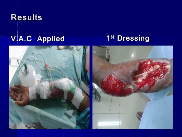 role of negative pressure wound therapy v a c in orthopaedics