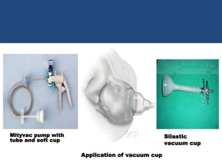 Silastic Application Method Vacuum Delivery | PPTX