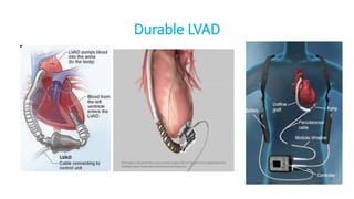 Lvad Map VAD | PPTX