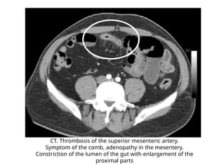 VAD - Acute and chronic disorders of mesenteric.pptx
