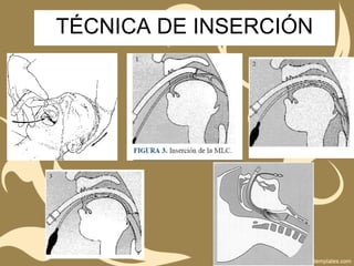 TÉCNICA DE INSERCIÓN
 