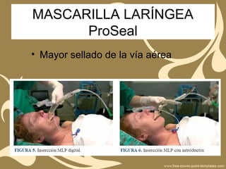 MASCARILLA LARÍNGEA
ProSeal
• Mayor sellado de la vía aérea
 