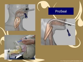 ProSeal
 