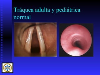Tráquea adulta y pediátrica
normal
 