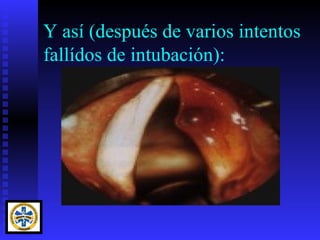 Y así (después de varios intentos
fallídos de intubación):
 