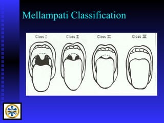 Mellampati Classification
 