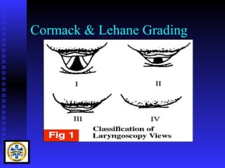 Cormack & Lehane Grading
 
