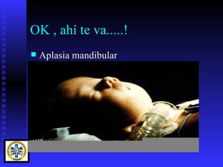 OK , ahí te va.....!
   Aplasia mandibular
 